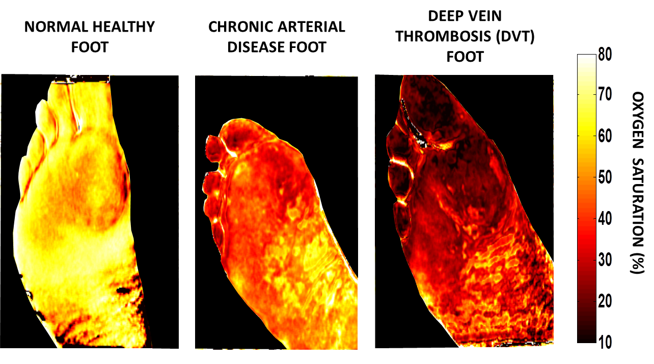 The images of an affected burn area produced by an SFDI surgical camera show parameters such as oxygen saturation, water content and total hemoglobin. (Photo by University of California, Irvine)