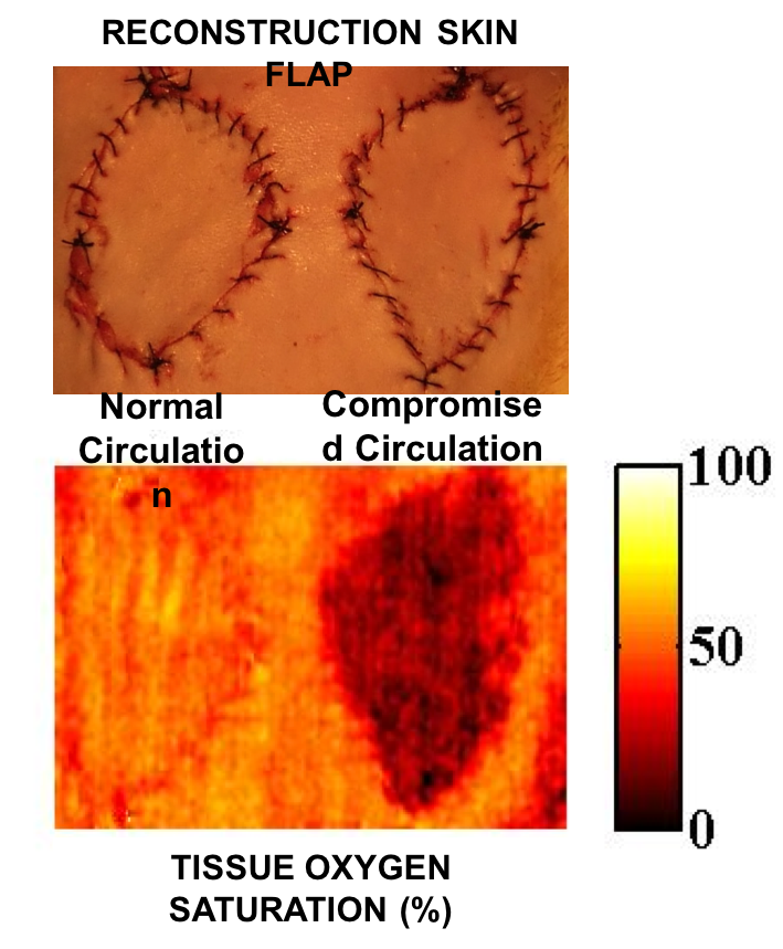 SFDI surgical camera images show reconstruction skin flaps with normal (A) and compromised (B) circulation. SFDI images enable physicians to make early and accurate assessments of tissue viability for burn and wound management, reconstructive surgery and progressive monitoring of grafts and wound healing. (Photo by University of California, Irvine)