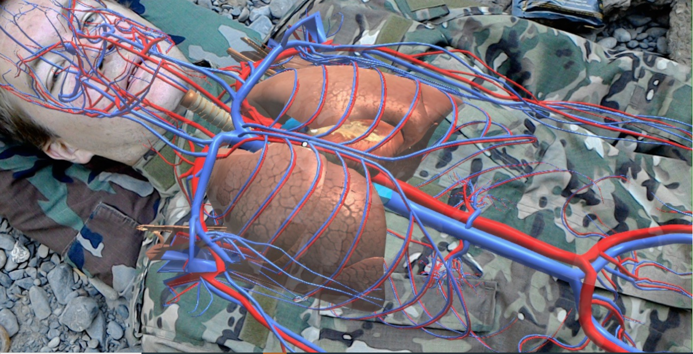 LIKE HAVING X-RAY VISION: A simulation shows the medic’s IVAS view of a battlefield casualty using the new augmented reality tool’s anatomy display capability. (Photo courtesy of Christoph Leuze, Nakamir Inc.)
